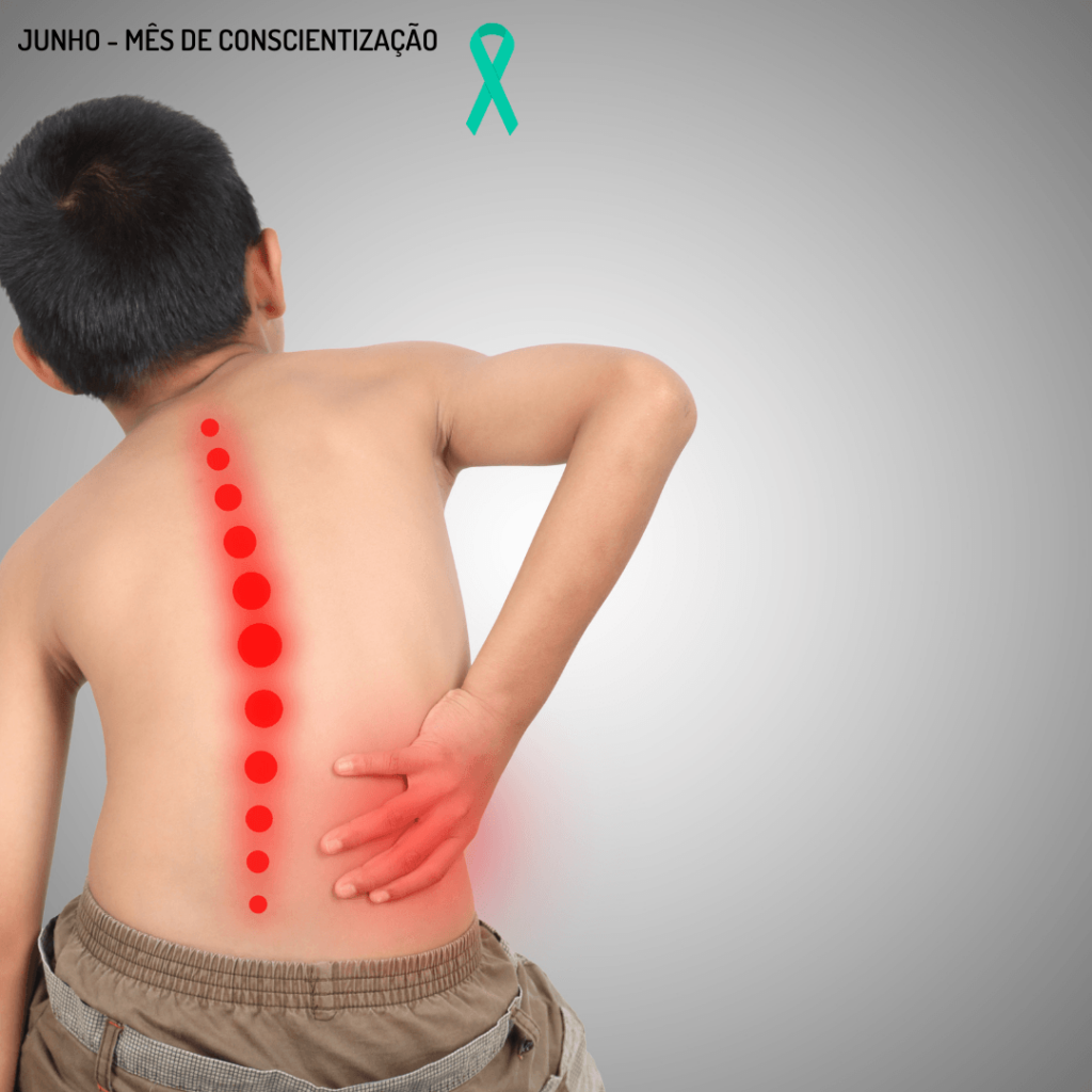Atenção aos sinais da escoliose na criança e adolescente